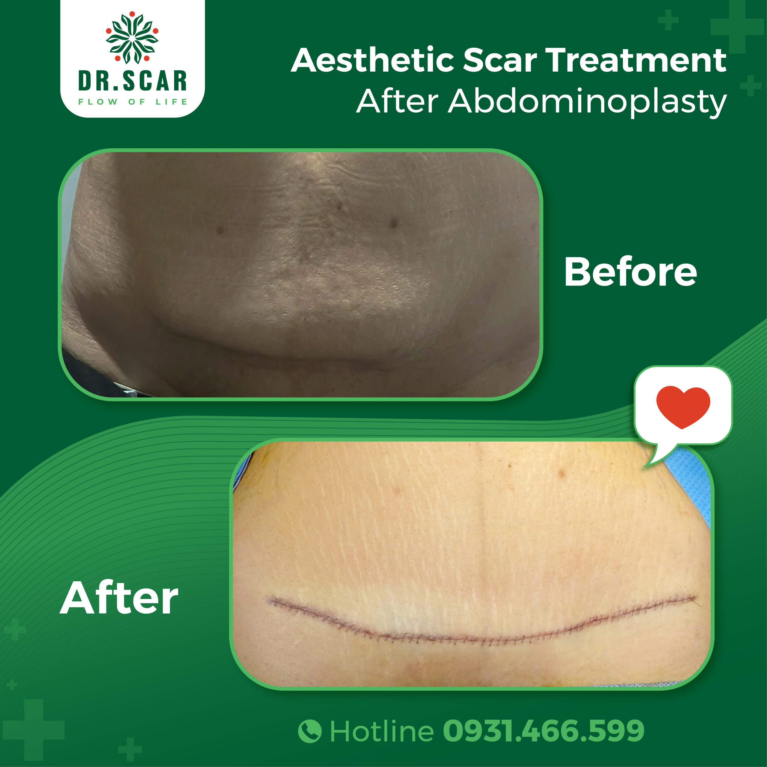 Effective Abdominoplasty Scar Treatment Solutions