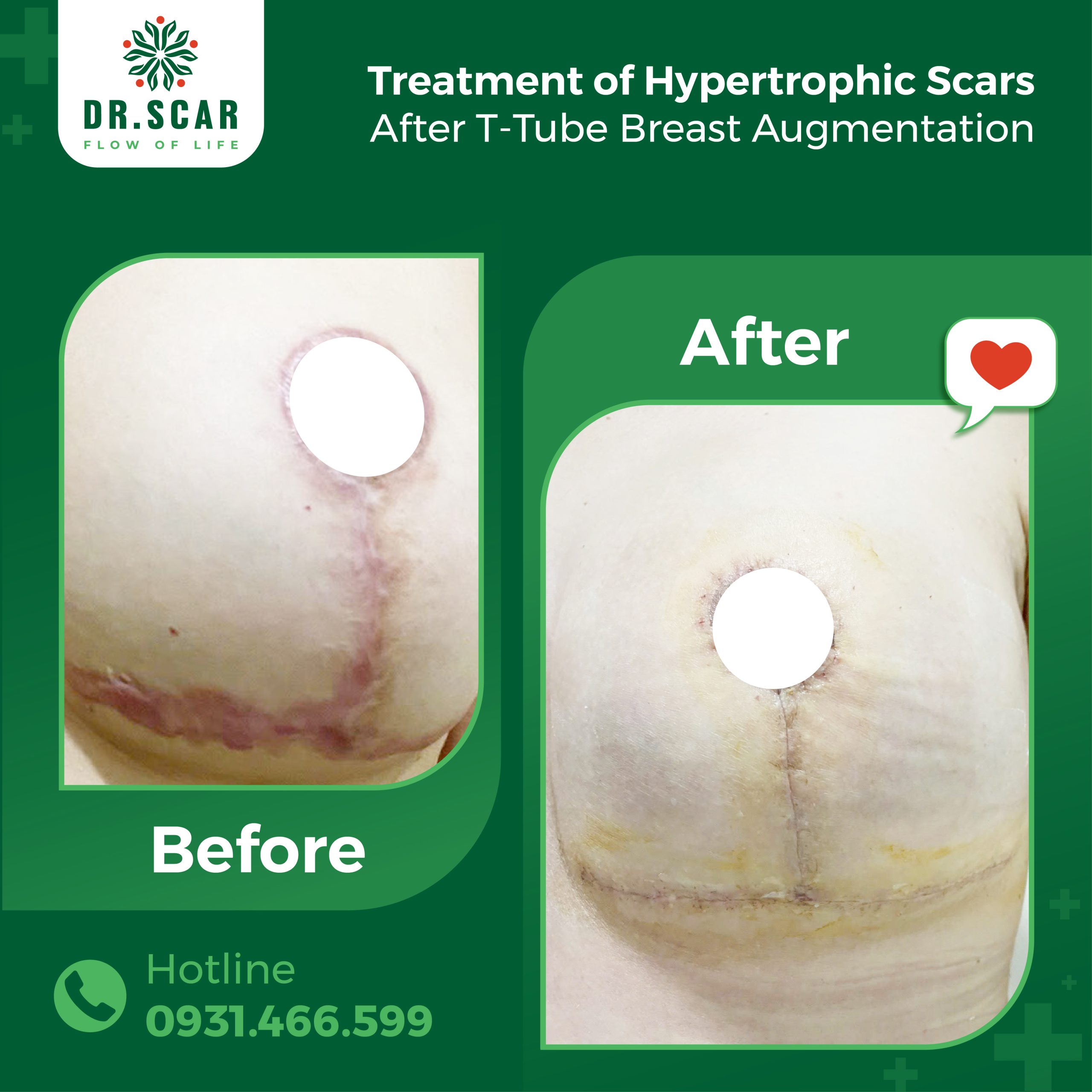 Hypertrophic Scar Treatment after T-shaped flap Mammoplasty